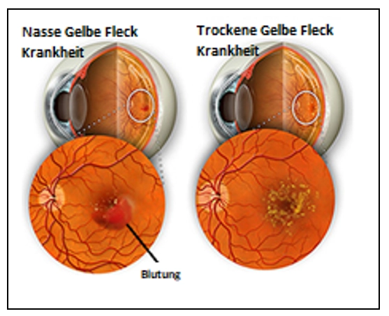 Gelbe Fleck-Krankheit