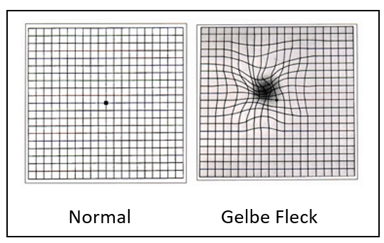 Gelbe Fleck-Krankheit