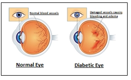 Diabetic Retinopathy (Retinal Damage Due To Diabetes)