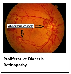 Diabetic Retinopathy (Retinal Damage Due To Diabetes)