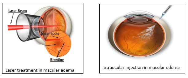Diabetic Retinopathy (Retinal Damage Due To Diabetes)
