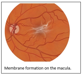Epiretinal Membrane