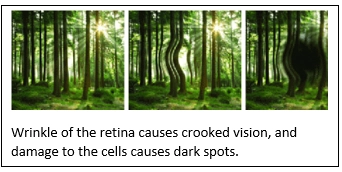Epiretinal Membrane