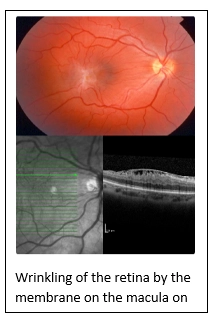 Epiretinal Membrane