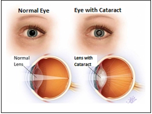 Cataract Treatment