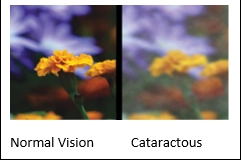 Cataract Treatment
