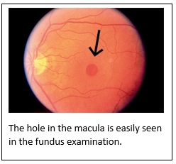 Macular Hole