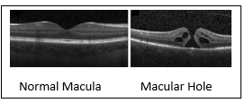 Macular Hole