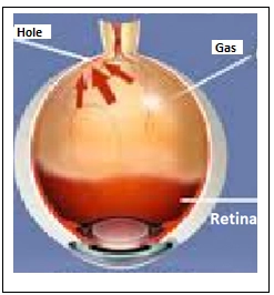 Macular Hole