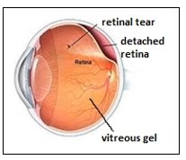 Retinal Tear and Retinal Detachment