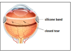 Retinal Tear and Retinal Detachment