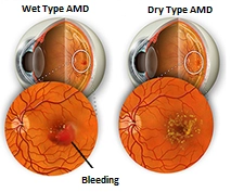 Yellow Spot Disease