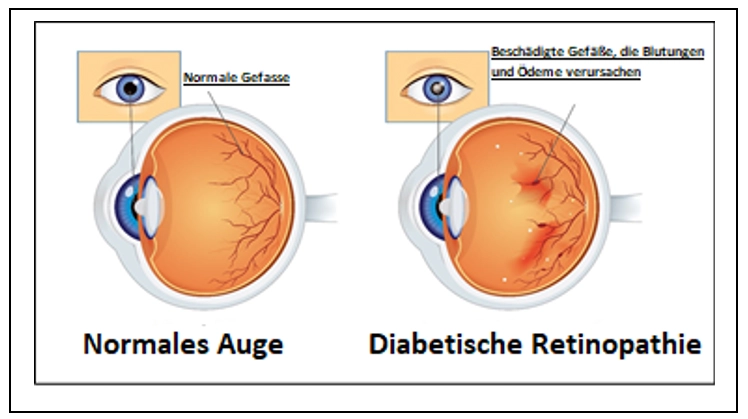 Diabetische Retinopathie (Netzhautschädigung durch Diabetes)