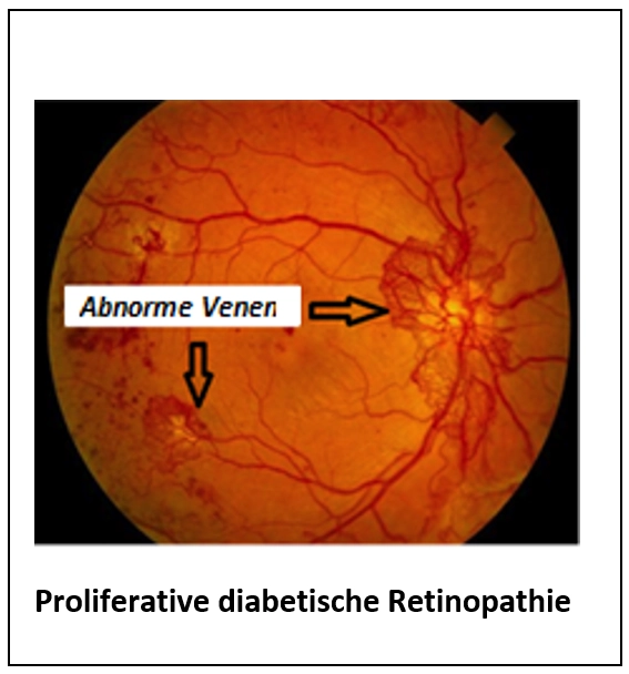 Diabetische Retinopathie (Netzhautschädigung durch Diabetes)