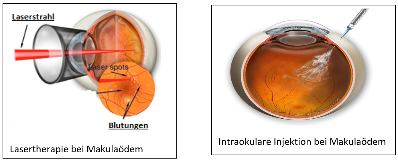 Diabetische Retinopathie (Netzhautschädigung durch Diabetes)