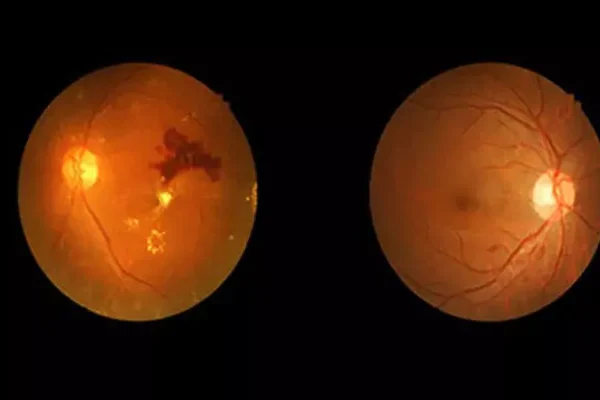 Diyabetik Retinopati