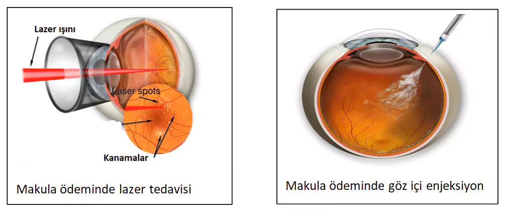Diyabetik Retinopati