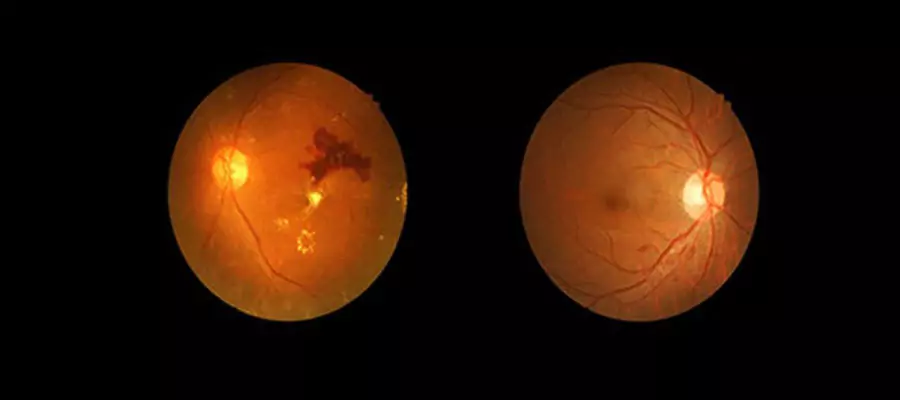 Diyabetik Retinopati
