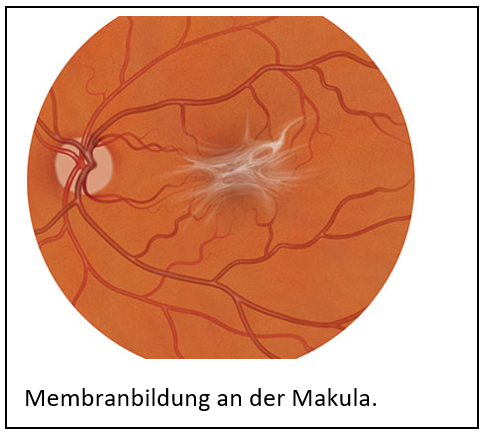 Epiretinale Membran