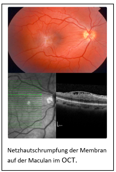Epiretinale Membran