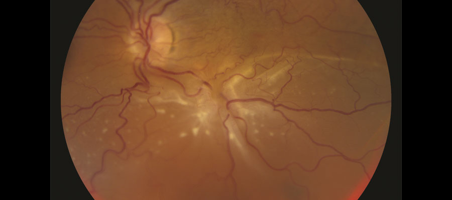 Retina Dekolmanı