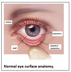 Pinguecula and Pterygium