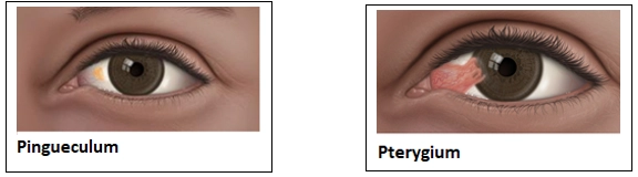 Pinguecula and Pterygium