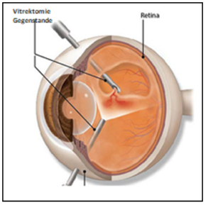 Vitrektomie