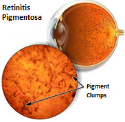 Retinitis Pigmentosa (Nyctalopia-Night Blindness)