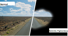 Retinitis Pigmentosa (Nyctalopia-Night Blindness)
