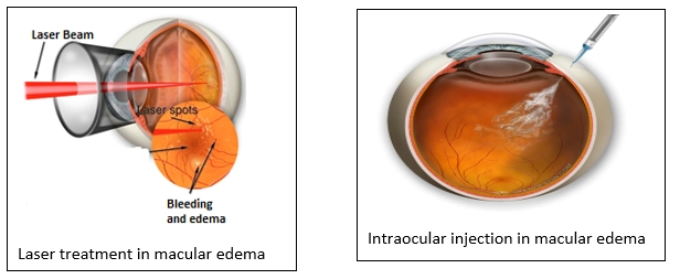 Retinal Vein Occlusion