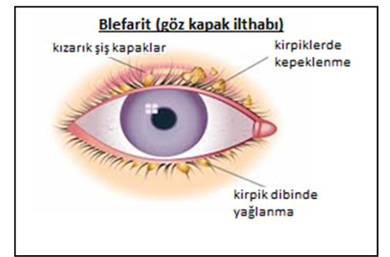 Blefarit