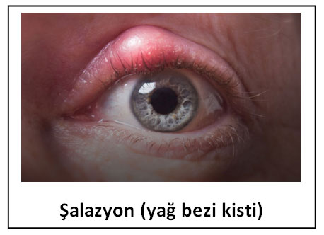 Bu görsel boş bir alt niteliğe sahip; dosya adı Blefarit2.jpg