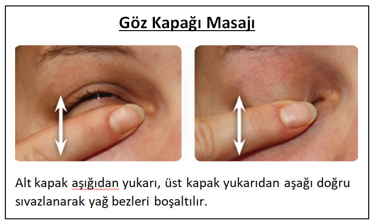 Blefarit (Göz Kapağı İltihabı)
