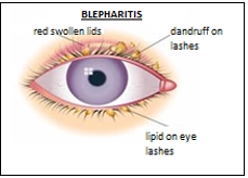 Blepharitis (Eyelid Inflammation)
