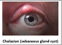 Blepharitis (Eyelid Inflammation)