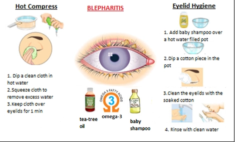 Blepharitis (Eyelid Inflammation)