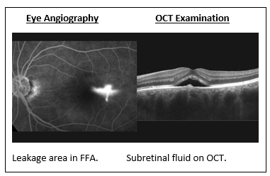 Central Serous Retinopathy