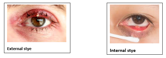 Stye and Chalazion