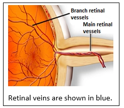 Retinal Vein Occlusion