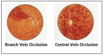 Retinal Vein Occlusion