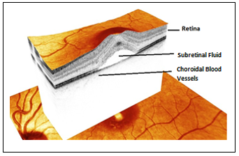 Central Serous Retinopathy