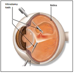 Vitrectomy