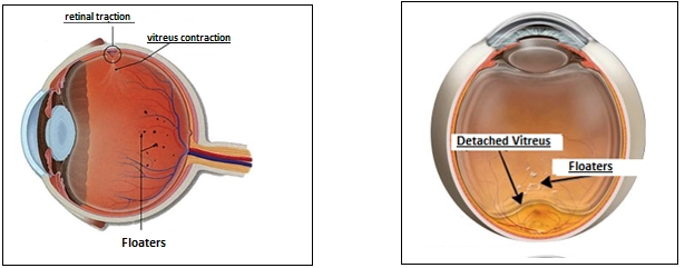 Flashes of Light (Photopsia) and Posterior Vitreous Detachment