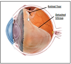 Flashes of Light (Photopsia) and Posterior Vitreous Detachment