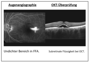 Zentrale Seröse Retinopathie