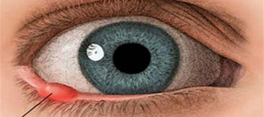 Stye and Chalazion