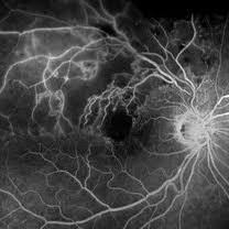 Retinal Vein Occlusion