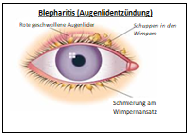 Blepharitis (Augenlidentzündung)