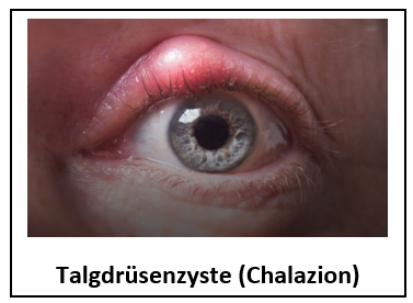 Blepharitis (Augenlidentzündung)